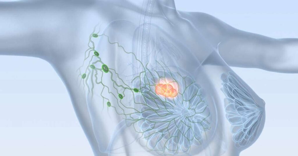 Câncer de Mama Metastático: Opções de tratamento e esperança de vida