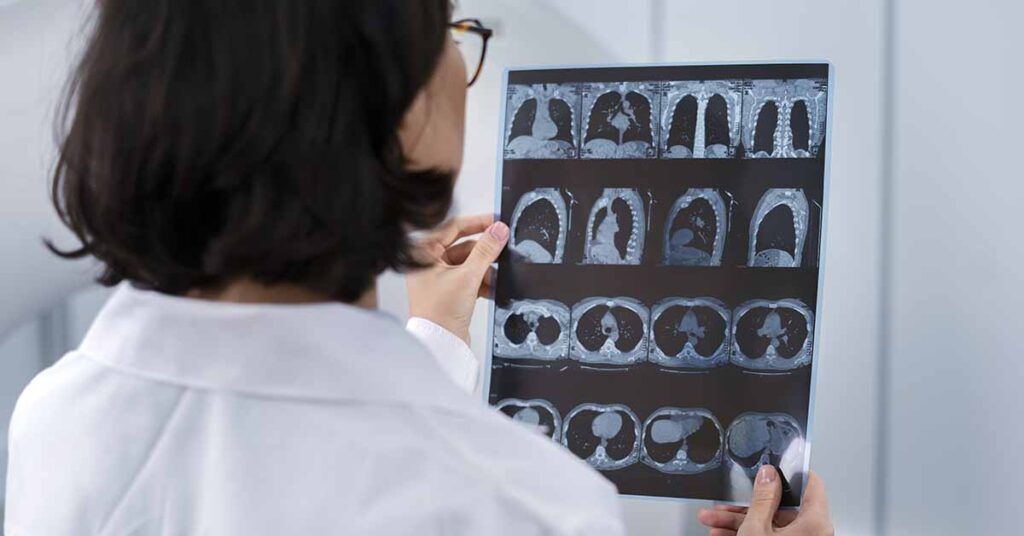 Sarcomas de partes moles e osteossarcomas: o que é isso?